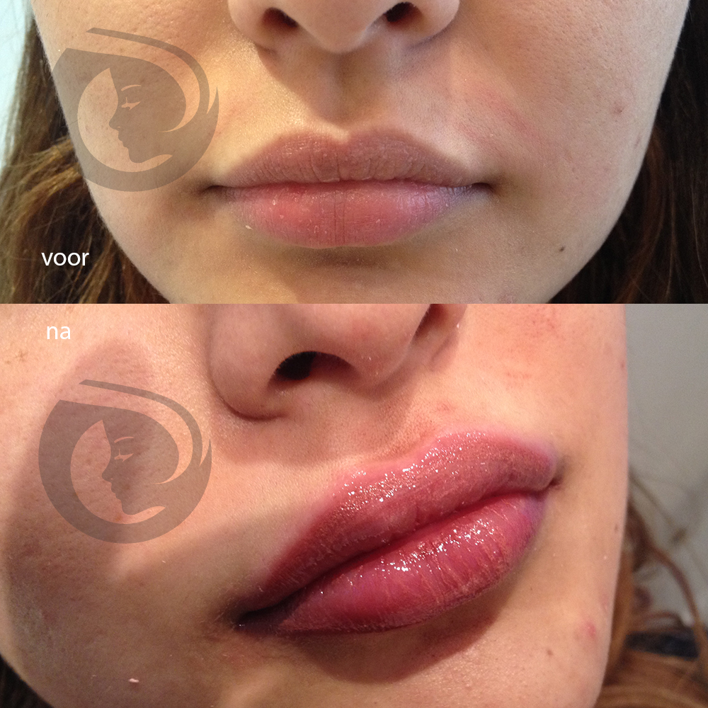 PMU fulllips